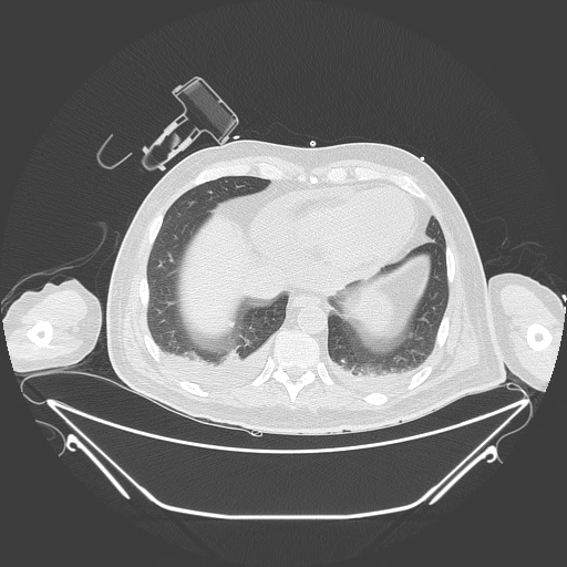 Aortic arch aneurysm (Radiopaedia 84109-99365 Axial lung window 218).jpg