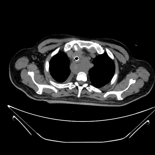 File:Aortic arch aneurysm (Radiopaedia 84109-99365 Axial non-contrast 55).jpg