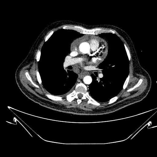 Aortic arch aneurysm (Radiopaedia 84109-99365 B 315).jpg