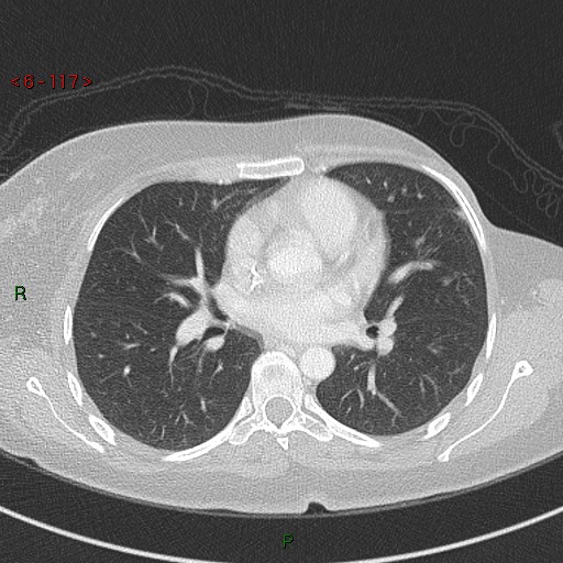 Aortic arch origin of left vertebral artery (Radiopaedia 51520-57286 Axial lung window 117).jpg
