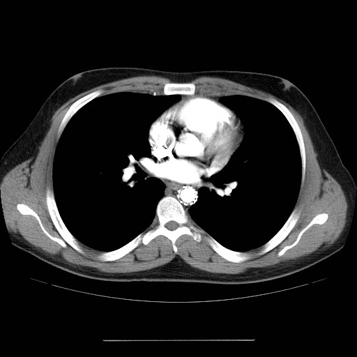 File:Aortic arch stent (Radiopaedia 30030-30595 D 20).jpg