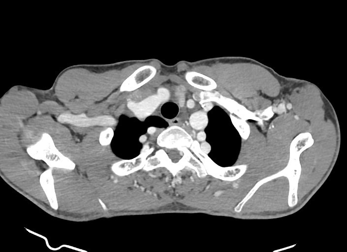 File:Aortic coarctation with aneurysm (Radiopaedia 74818-85828 A 172).jpg