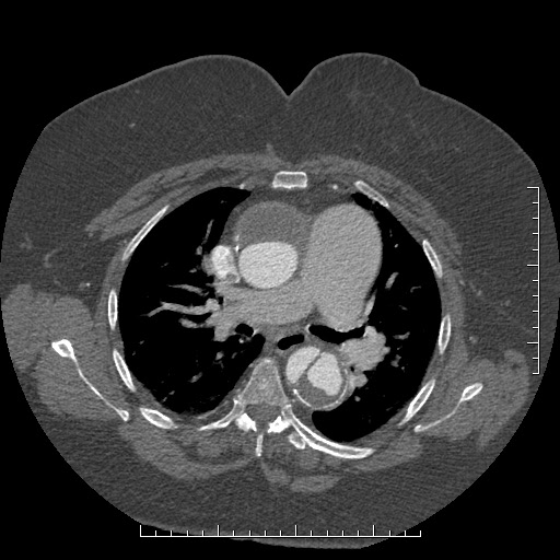 Aortic dissection- Stanford A (Radiopaedia 35729-37268 A 34).jpg