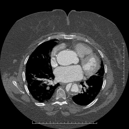 Aortic dissection- Stanford A (Radiopaedia 35729-37268 A 53).jpg