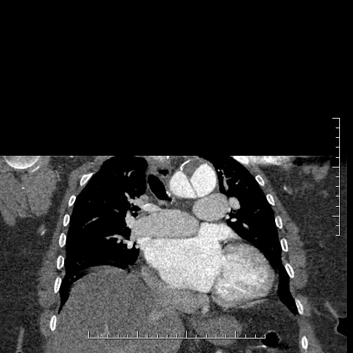 Aortic dissection- Stanford A (Radiopaedia 35729-37268 E 29).jpg