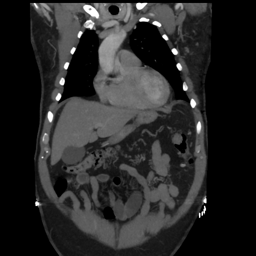 File:Aortic dissection- Stanford A (Radiopaedia 37759-39664 Coronal C+ delayed 10).png