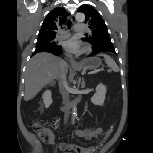 File:Aortic dissection- Stanford A (Radiopaedia 37759-39664 Coronal C+ delayed 25).png