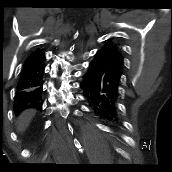 Aortic dissection (CTPA) (Radiopaedia 75506-86750 B 64).jpg