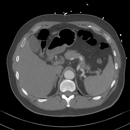 File:Aortic dissection (Radiopaedia 50763-56234 A 78).png