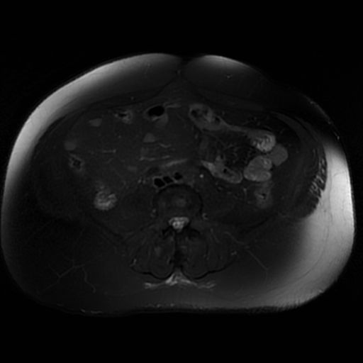 File:Aortic dissection (Radiopaedia 57969-64956 Axial T2 fat sat 47).jpg