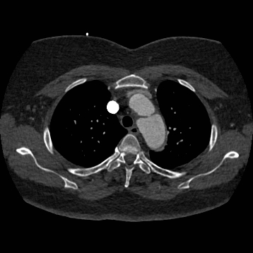 File:Aortic dissection (Radiopaedia 57969-64959 A 87).jpg