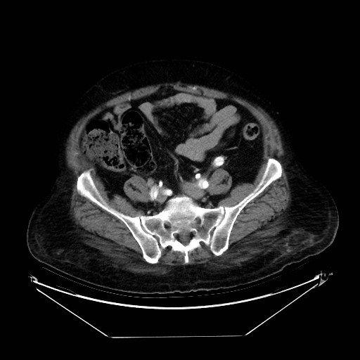 Aortic dissection (Radiopaedia 62562-71000 A 90).jpg