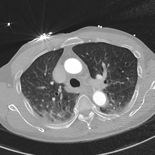 Aortic dissection - DeBakey type II (Radiopaedia 64302-73082 Axial lung window 21).png