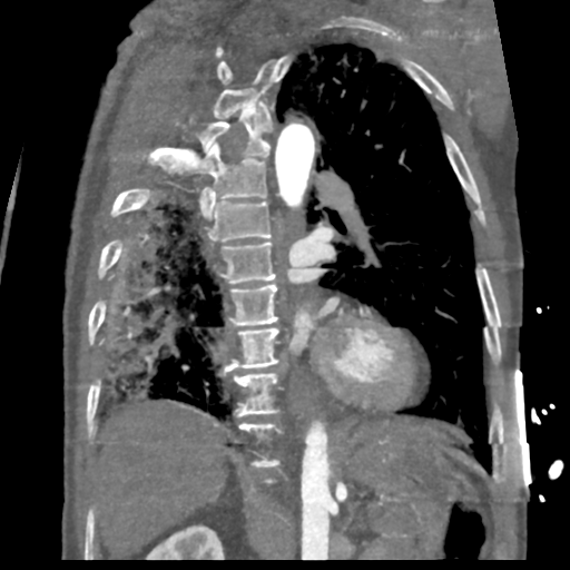 File:Aortic dissection - DeBakey type II (Radiopaedia 64302-73082 D 26).png