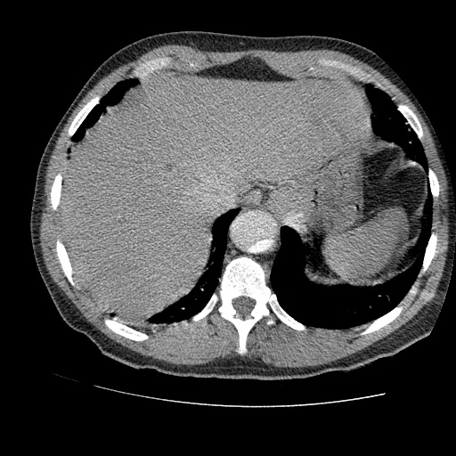 File:Aortic dissection - Stanford A -DeBakey I (Radiopaedia 28339-28587 B 88).jpg