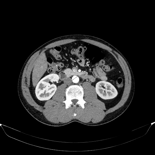 Aortic dissection - Stanford type A (Radiopaedia 83418-98500 A 78).jpg