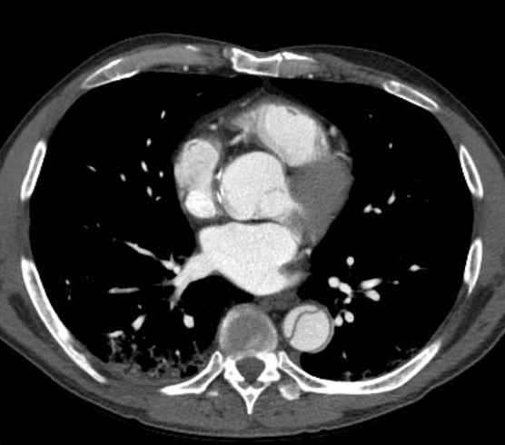 Aortic dissection - Stanford type B (Radiopaedia 73648-84437 A 65).jpg