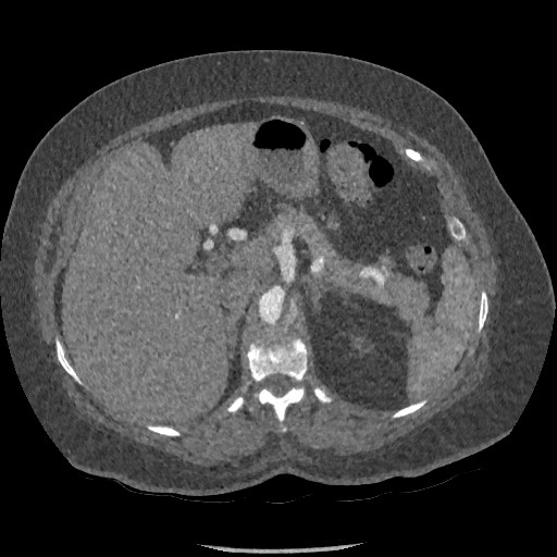 File:Aortic dissection - Stanford type B (Radiopaedia 88281-104910 A 103).jpg