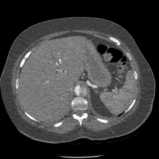 Aortic dissection - Stanford type B (Radiopaedia 88281-104910 A 94).jpg