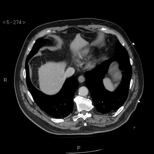File:Aortic intramural hematoma (Radiopaedia 48463-53380 C 124).jpg