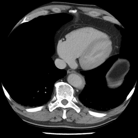 Aortic intramural hematoma (type B) (Radiopaedia 79323-92387 Axial C+ delayed 42).jpg