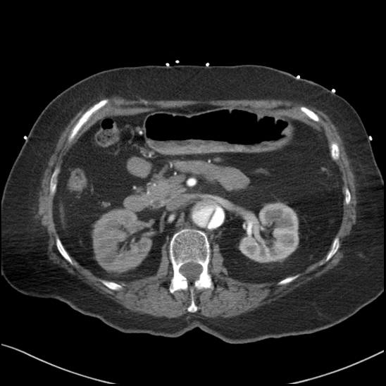 Aortic intramural hematoma with dissection and intramural blood pool (Radiopaedia 77373-89491 B 122).jpg