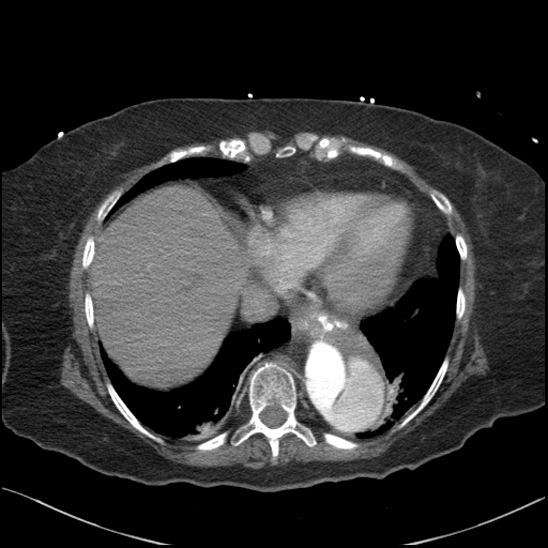 Aortic intramural hematoma with dissection and intramural blood pool (Radiopaedia 77373-89491 B 86).jpg