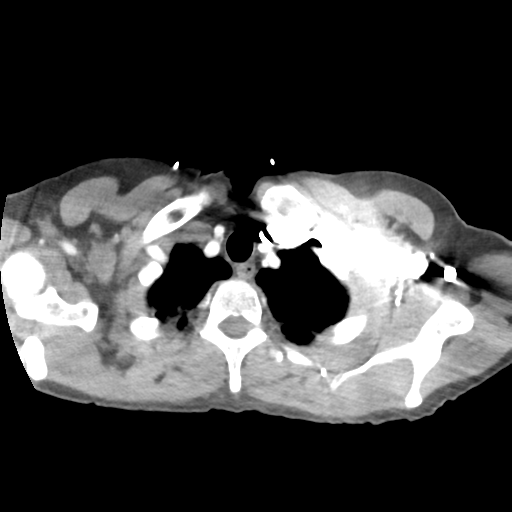 File:Aortic valve non-coronary cusp thrombus (Radiopaedia 55661-62189 B 6).png