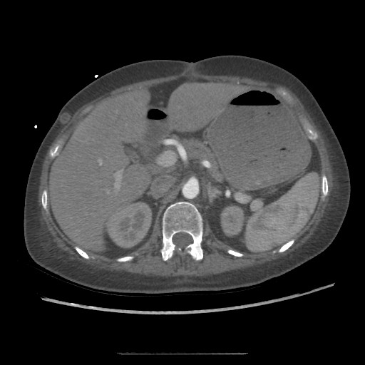 Aorto-duodenal fistula (Radiopaedia 25668-25850 A 16).jpg