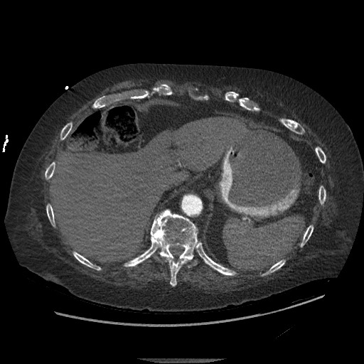 Aortoesophageal fistula with endovascular repair (Radiopaedia 73781-84592 Axial C+ CTPA 158).jpg