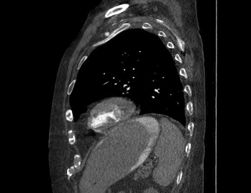 Aortoesophageal fistula with endovascular repair (Radiopaedia 73781-84592 Sagittal C+ CTPA 153).jpg