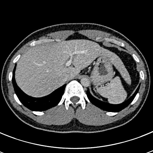 Apical lung mass mimic - neurogenic tumor (Radiopaedia 59918-67521 A 76).jpg