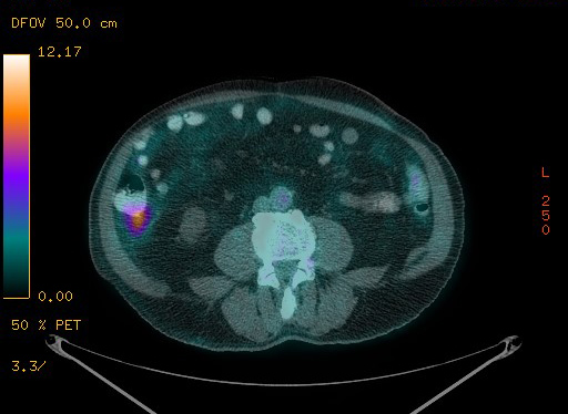 Appendiceal adenocarcinoma complicated by retroperitoneal abscess (Radiopaedia 58007-65041 Axial PET-CT 141).jpg