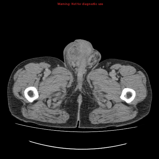 File:Appendicitis mass in inguinal hernia (Radiopaedia 26858-27029 A 43).jpg