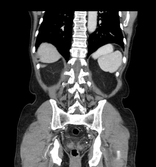 Appendicitis with localized perforation and abscess formation (Radiopaedia 49035-54130 B 38).jpg