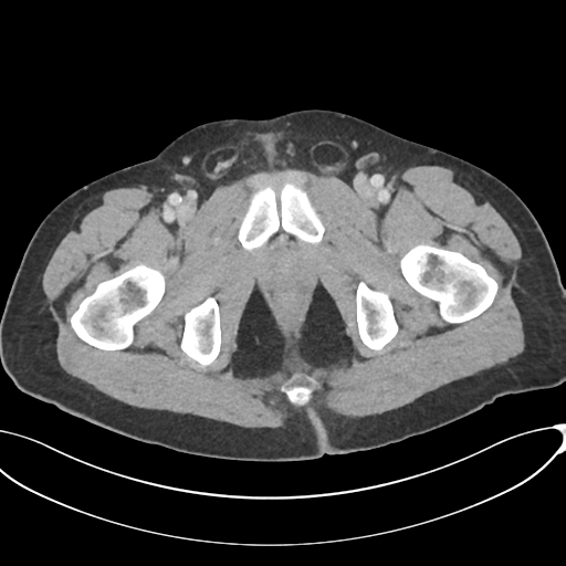 Appendicitis with thickening of the terminal ileum (Radiopaedia 42432-45550 A 98).png
