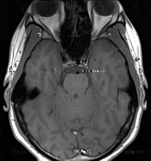 File:Arachnoid cyst - cerebellopontine angle (Radiopaedia 59689-67083 Axial T1 16).png