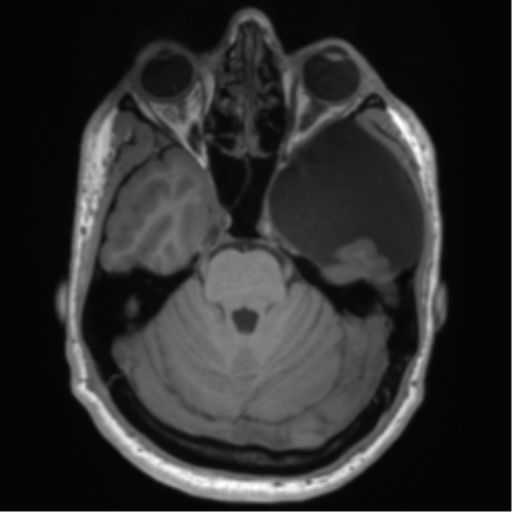 File:Arachnoid cyst with subdural hematoma (Radiopaedia 85892-101743 Axial T1 30).png