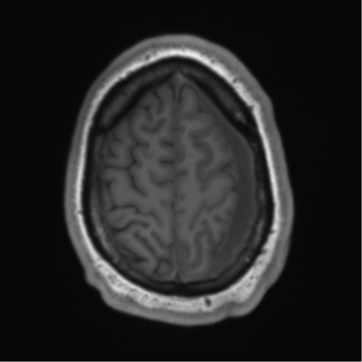 File:Arachnoid cyst with subdural hematoma (Radiopaedia 85892-101743 Axial T1 72).png