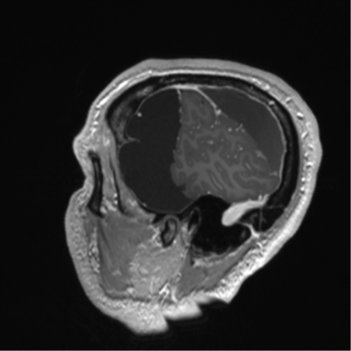 Arachnoid cyst with subdural hematoma (Radiopaedia 85892-101743 Sagittal T1 C+ 18).png