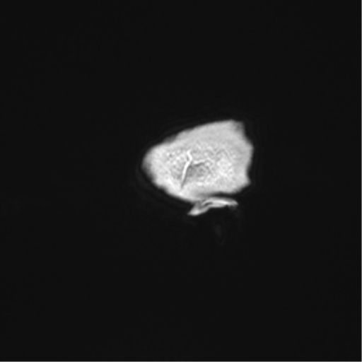 Arachnoid cyst with subdural hematoma (Radiopaedia 85892-101743 Sagittal T1 C+ 3).png
