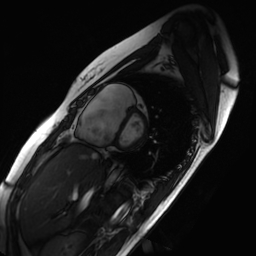 Arrhythmogenic right ventricular cardiomyopathy (Radiopaedia 87505-103850 short axis Cine SSFP 172).jpg