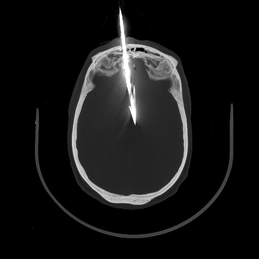 File:Arrow injury to the brain (Radiopaedia 72101-82607 Axial 1).jpg