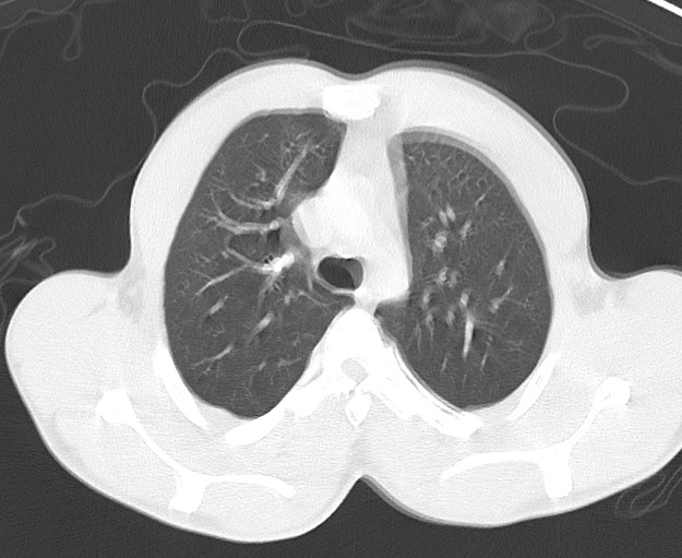 Arrow injury to the chest (Radiopaedia 75223-86321 Axial lung window 16).jpg
