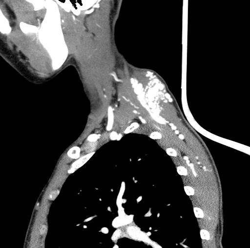Arteriovenous malformation of the neck (Radiopaedia 53935-60062 C 20).jpg