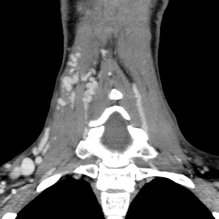 Arteriovenous malformation of the neck (Radiopaedia 53935-60062 D 30).jpg