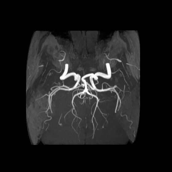 Artery of Percheron infarct (Radiopaedia 40966-43676 F 46).jpg
