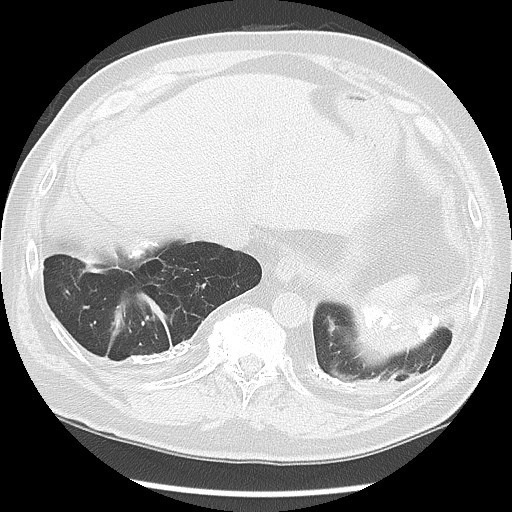 Asbestos-related pleural disease (Radiopaedia 74366-85250 Axial lung window 96).jpg