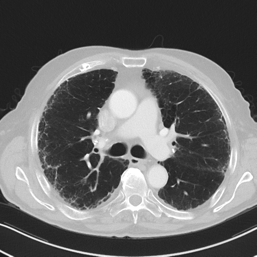 File:Asbestosis (Radiopaedia 56192-62864 Axial lung window 28).png