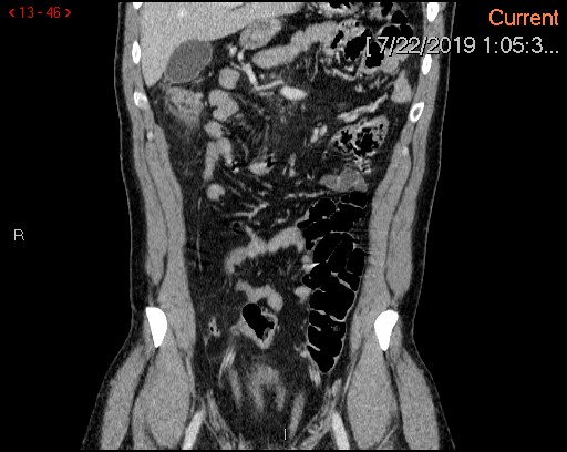 File:Ascending colonic diverticulum mimicking acute appendicitis (Radiopaedia 69943-80198 B 46).jpg